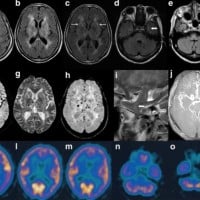 Fatal Familial Insomnia