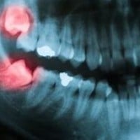 Getting teeth pulled doesn't hurt